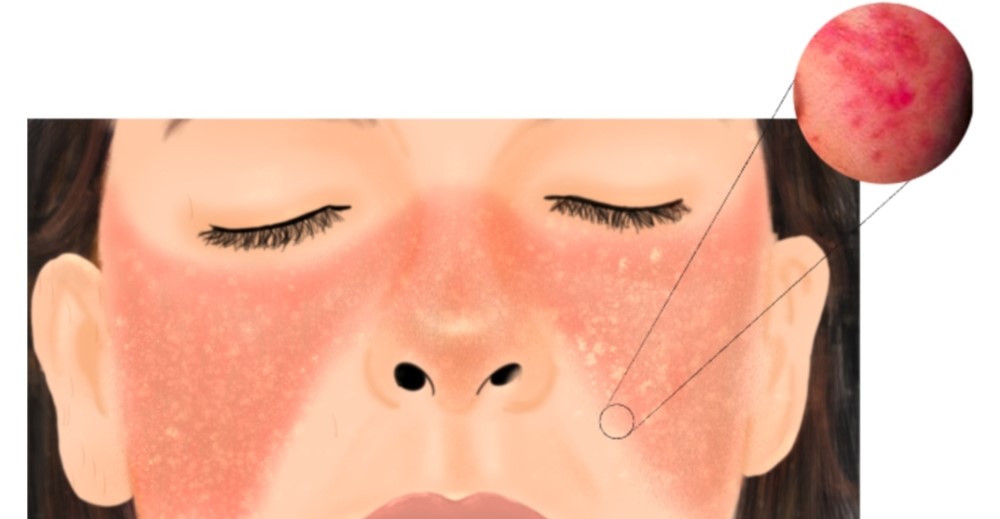 totul-despre-bolile-de-piele eruptie in forma de fluture specifica lupus