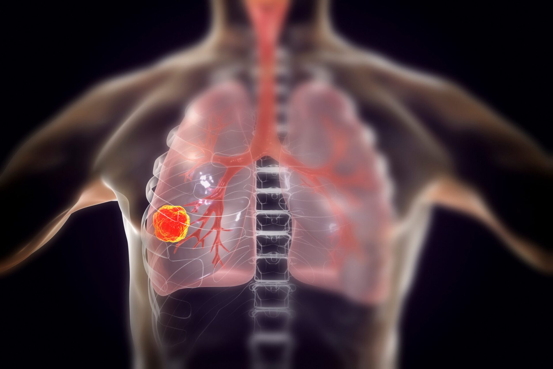 Totul despre cancer. Cancer pulmonar