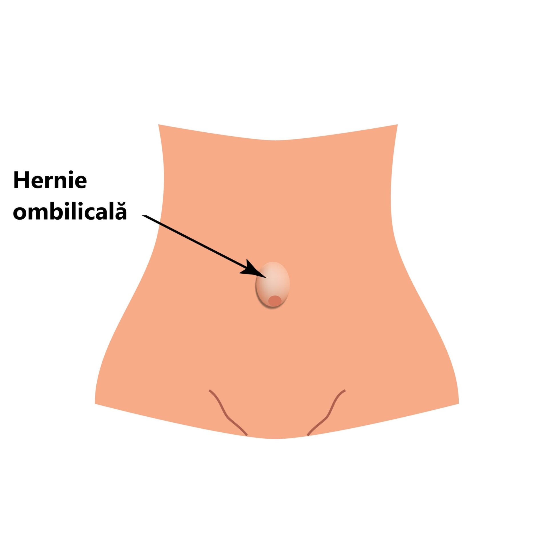 hernie-ombilicală-poze