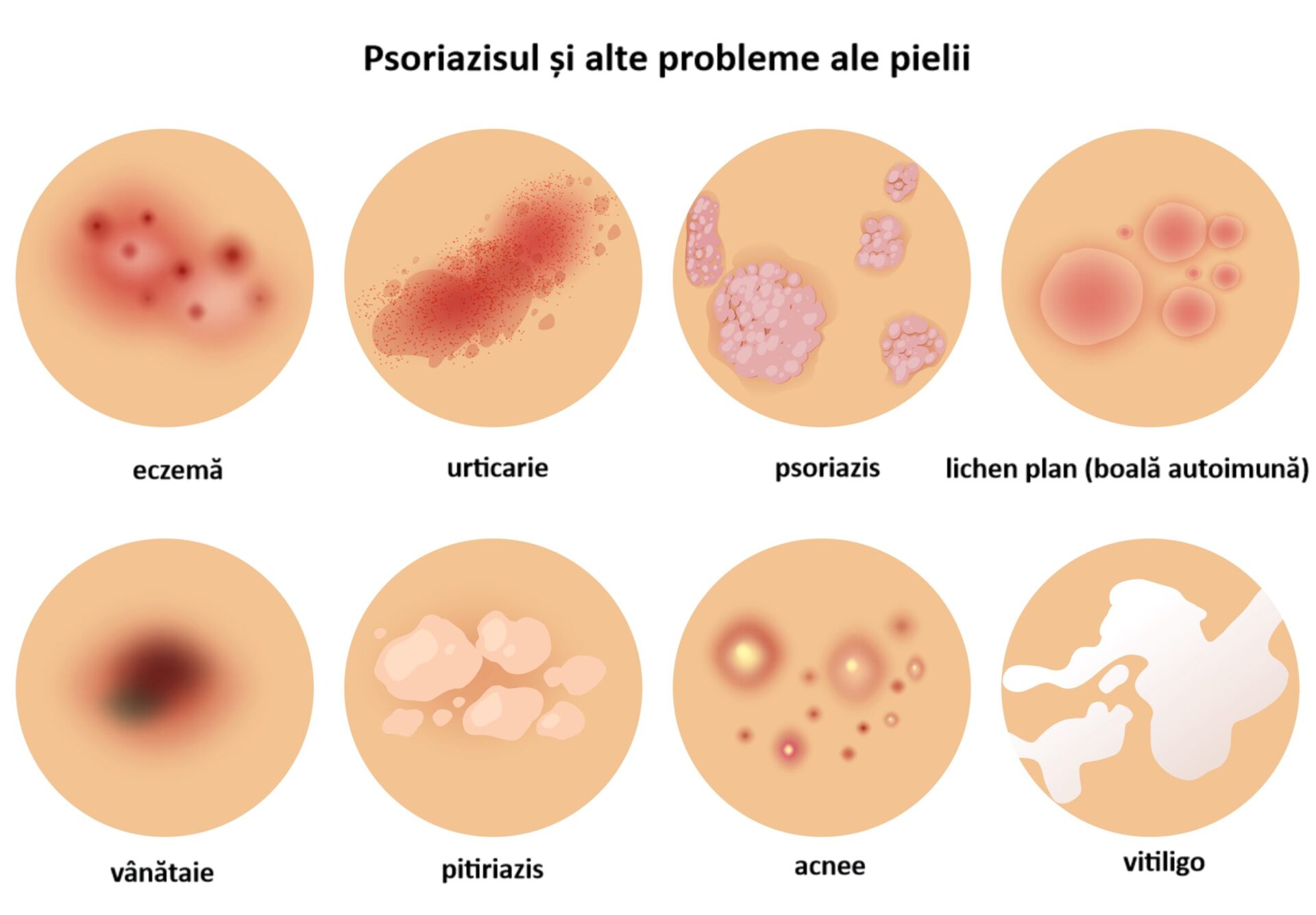 psoriazis și alte boli de piele