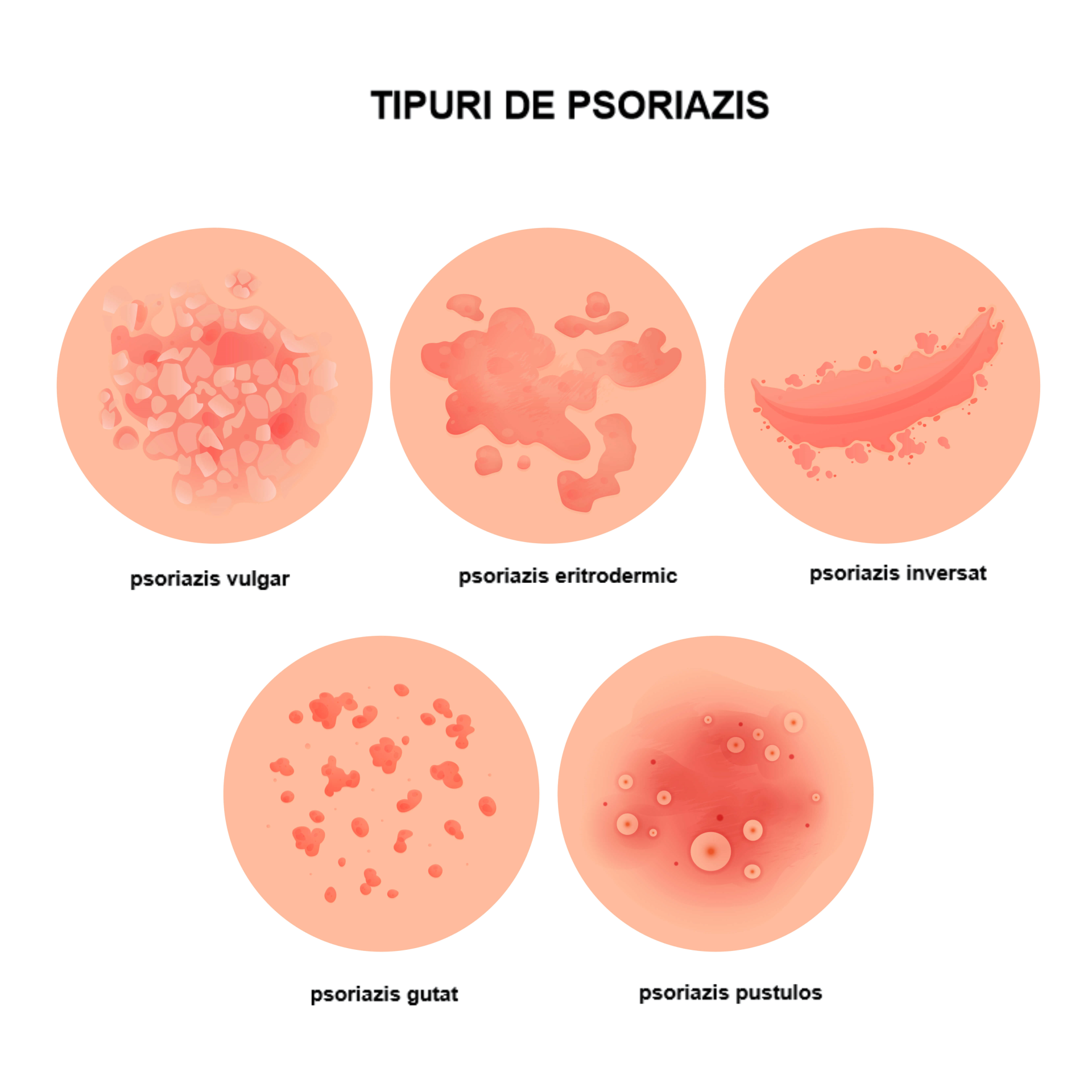 boli de piele poze psoriazis