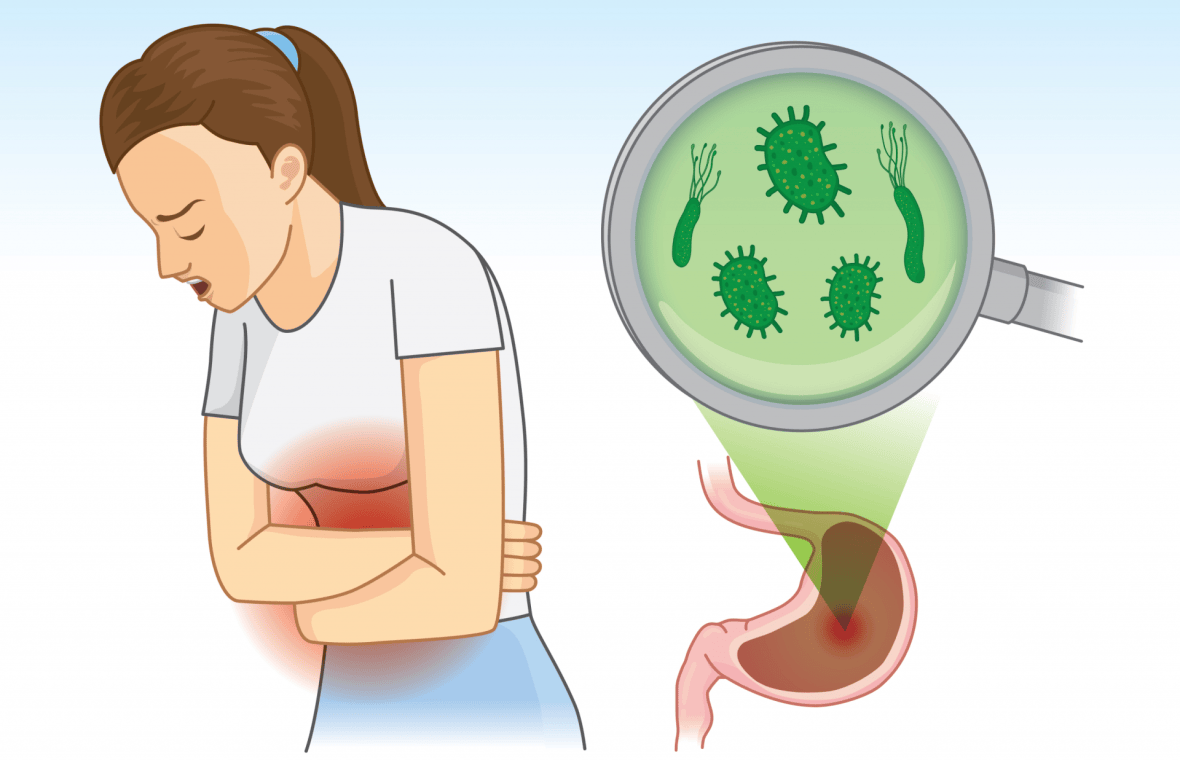Răceala intestinelor este termenul popular, nemedical pentru diagnosticul de gastroenterită acută.