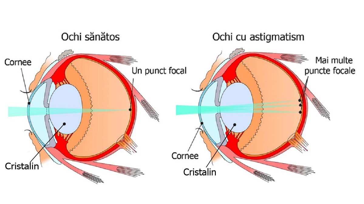 astigmatismul. grafic ochi