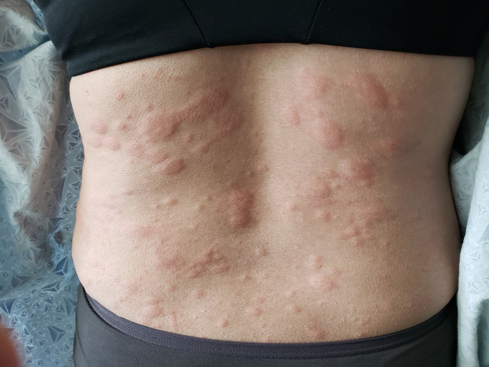 Boli de piele poze. Urticaria este una dintre bolile de piele frecvent întâlnite