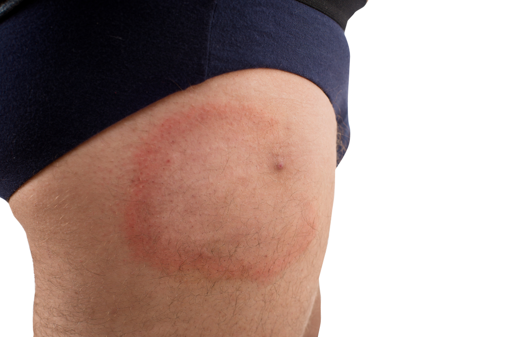 Cum arată eritemul migrator, erupția care semnalează boala Lyme Foto: Shutterstock