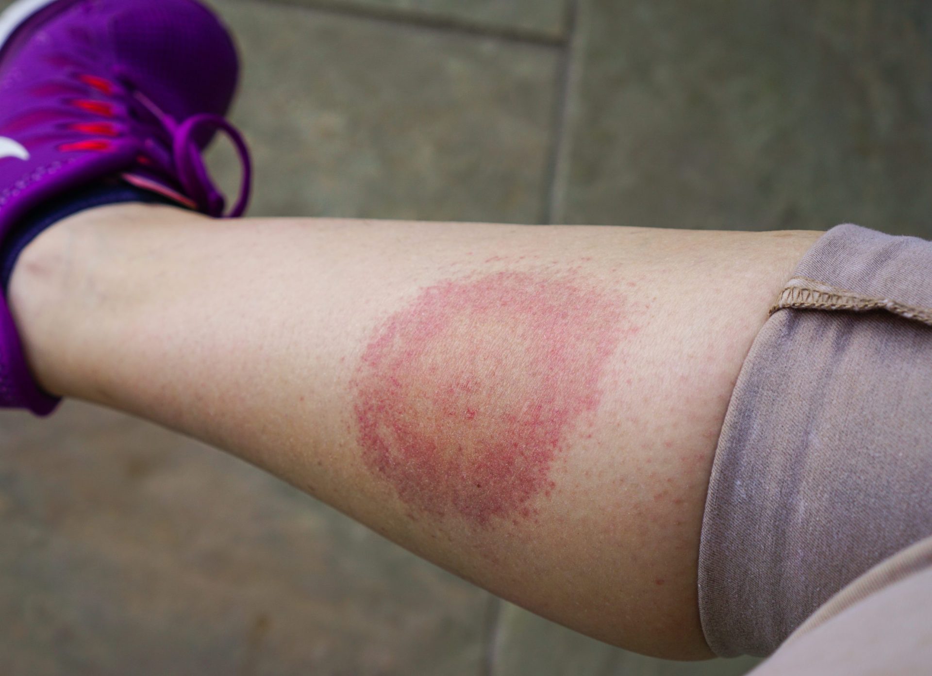 Cum arată eritemul migrator, erupția care semnalează boala Lyme Foto: Shutterstock