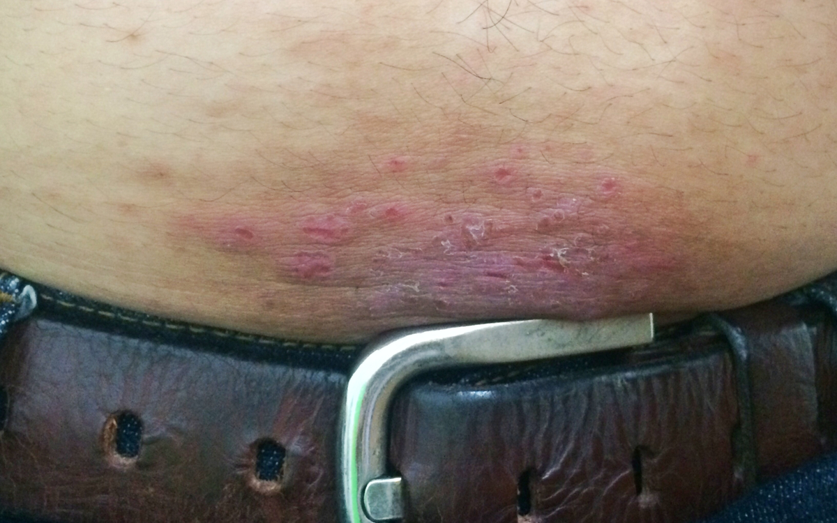 eczema-tipuri-factori-declansatori-si-tratament-eficient eczema atopica