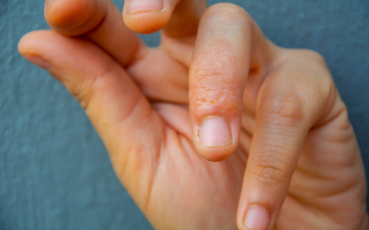 eczema-tipuri-factori-declansatori-si-tratament-eficient dermatita dishidrotica