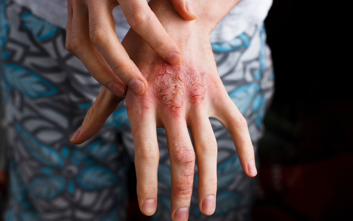 boli de piele poze eczema