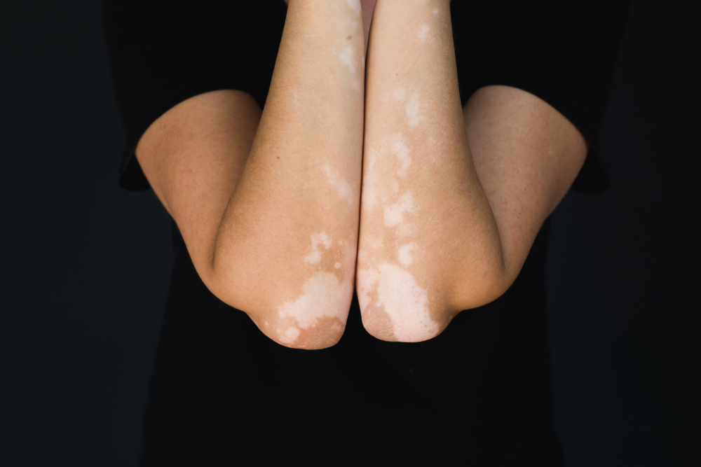 vitiligo coate