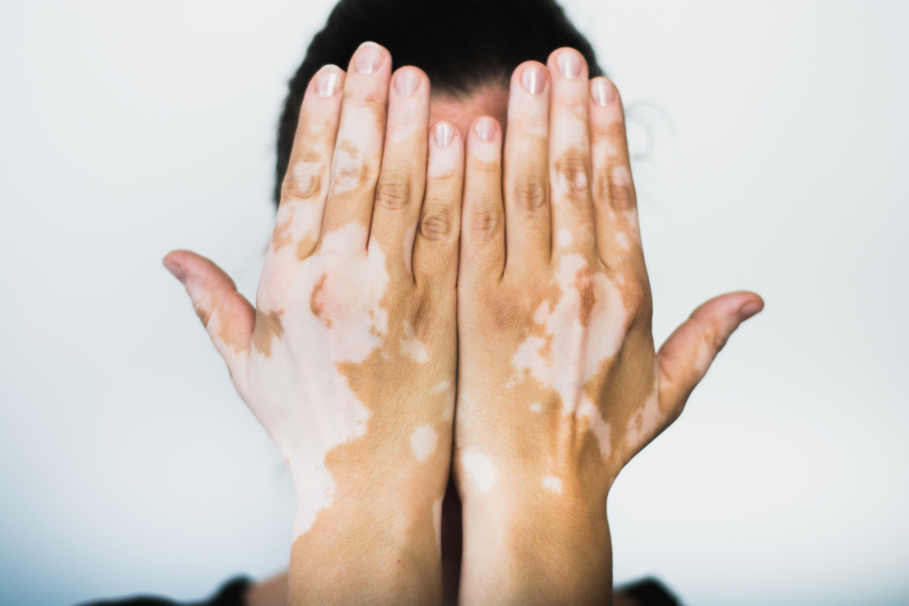 vitiligo palme