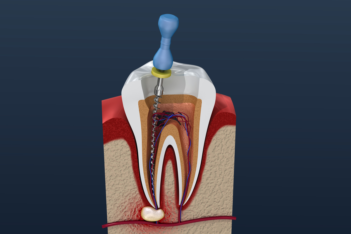 abces-dentar-urgenta-stomatologica-nu-e-bine-sa-il-spargi tratament de canal