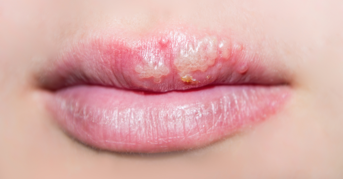 herpes-oral-cauze-simptome-tratament-si-remedii etapa 2