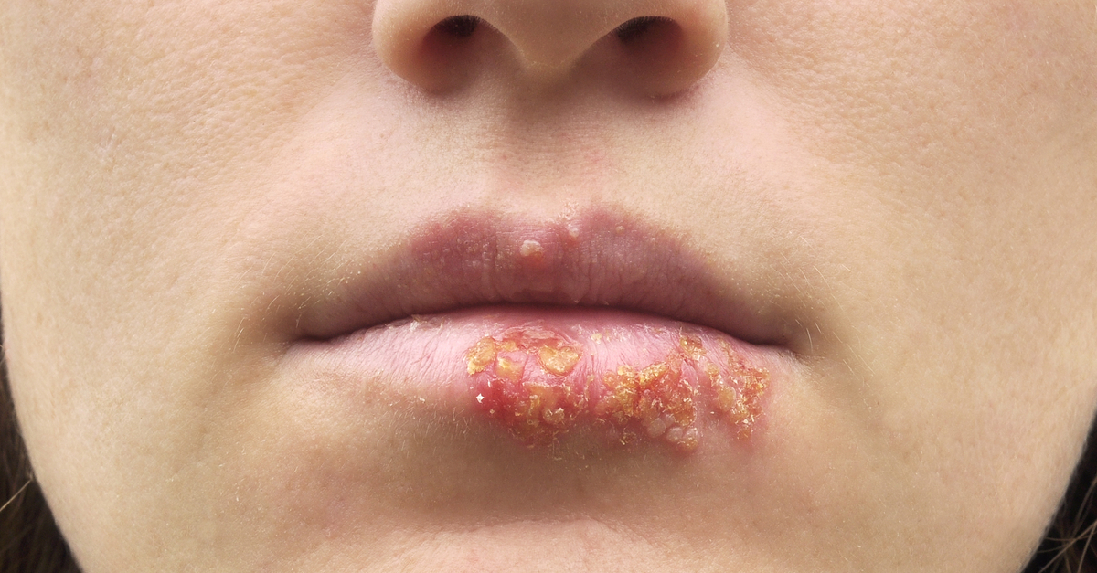 herpes-oral-cauze-simptome-tratament-si-remedii etapa 3