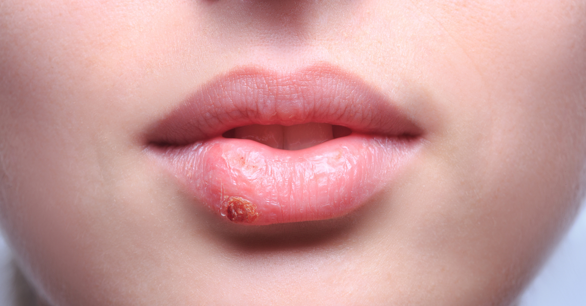 Bolile de piele: herpesul oral