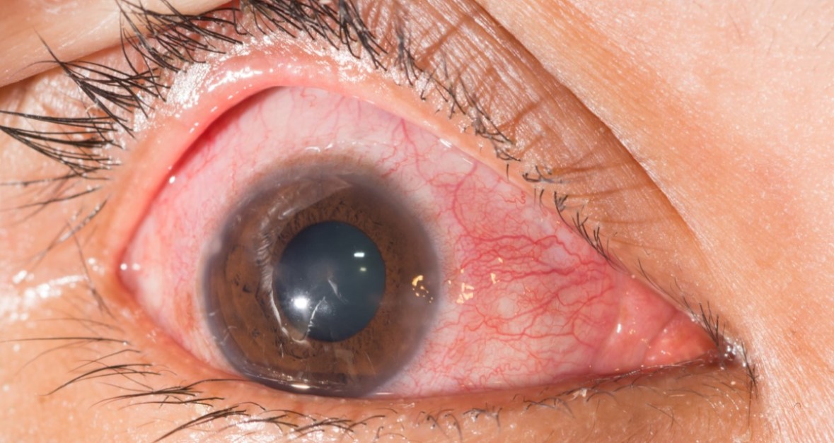 herpes-oral-cauze-simptome-tratament-si-remedii keratita herpetica