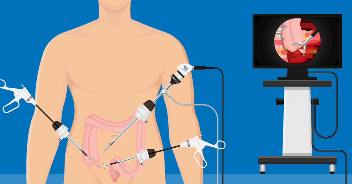 operatie-de-apendicita-acuta-laparoscopic-pregatire-cat-dureaza trocare