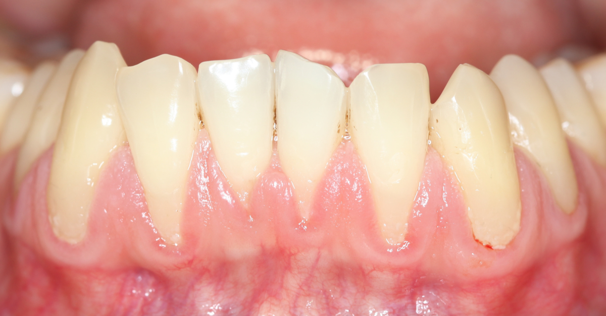 sângerările gingivale boala parodontala