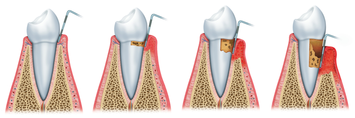 sangerarile gingivale parodontometrie