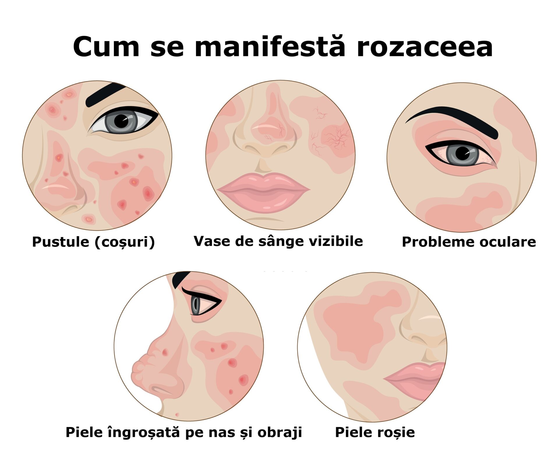 simptome rozacee