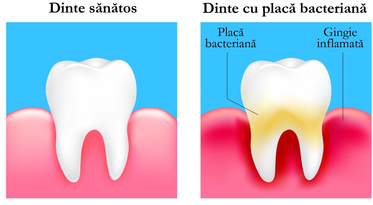 tartru-dentar-de-ce-apare-si-cum-scapam-de-el-definitiv gingivita