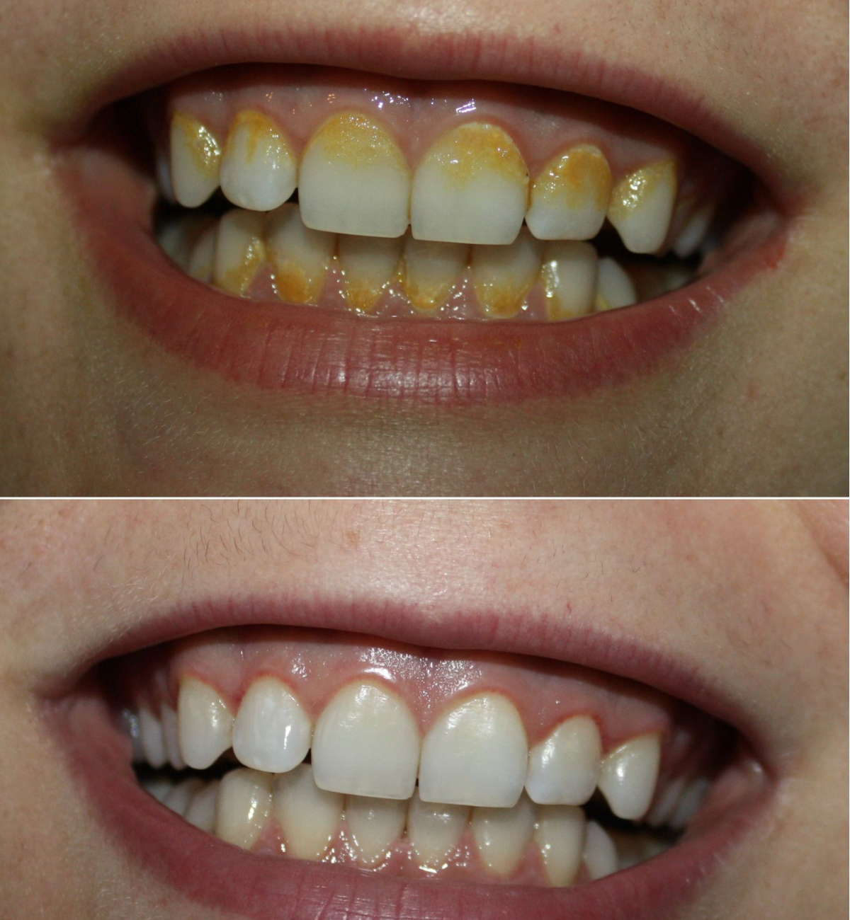 tartru-dentar-de-ce-apare-si-cum-scapam-de-el-definitiv inainte si dupa