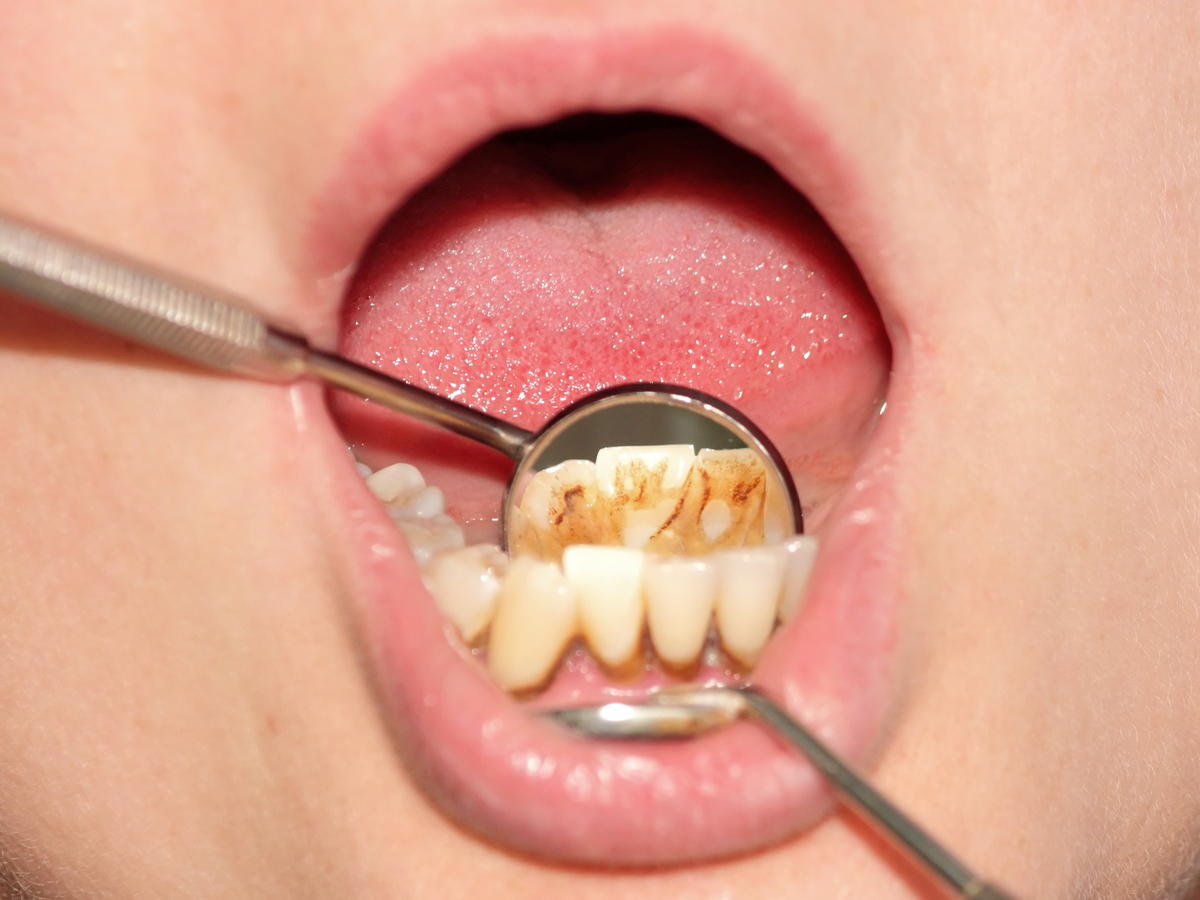 tartru-dentar-de-ce-apare-si-cum-scapam-de-el-definitiv Tartru acumulat