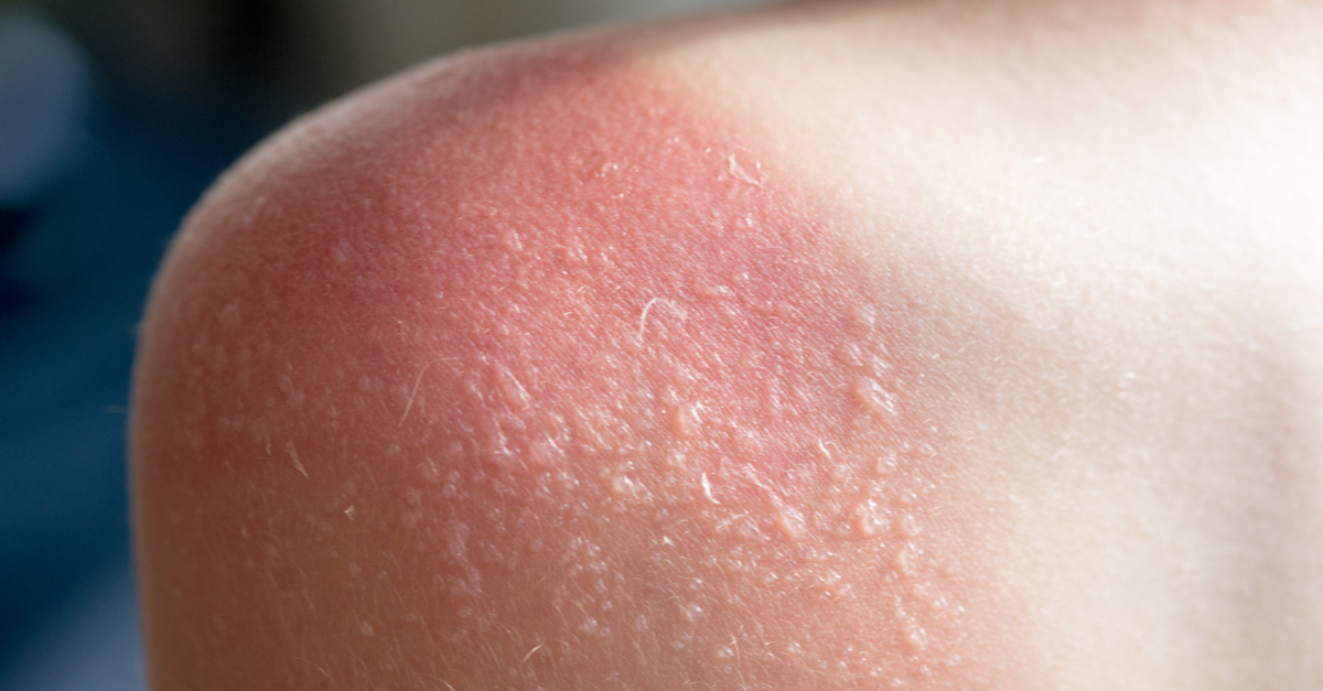 tratament-arsuri-solare-pasi-de-urmat-in-cazul-adultilor-si-copiilor arsura severa