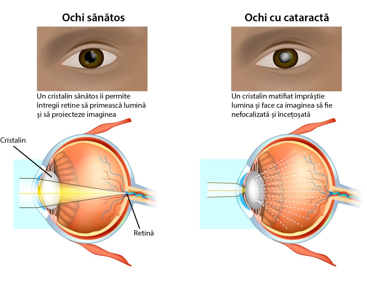 cataracta-se-vindeca-doar-cu-operatie-care-sunt-simptomele grafic cataracta
