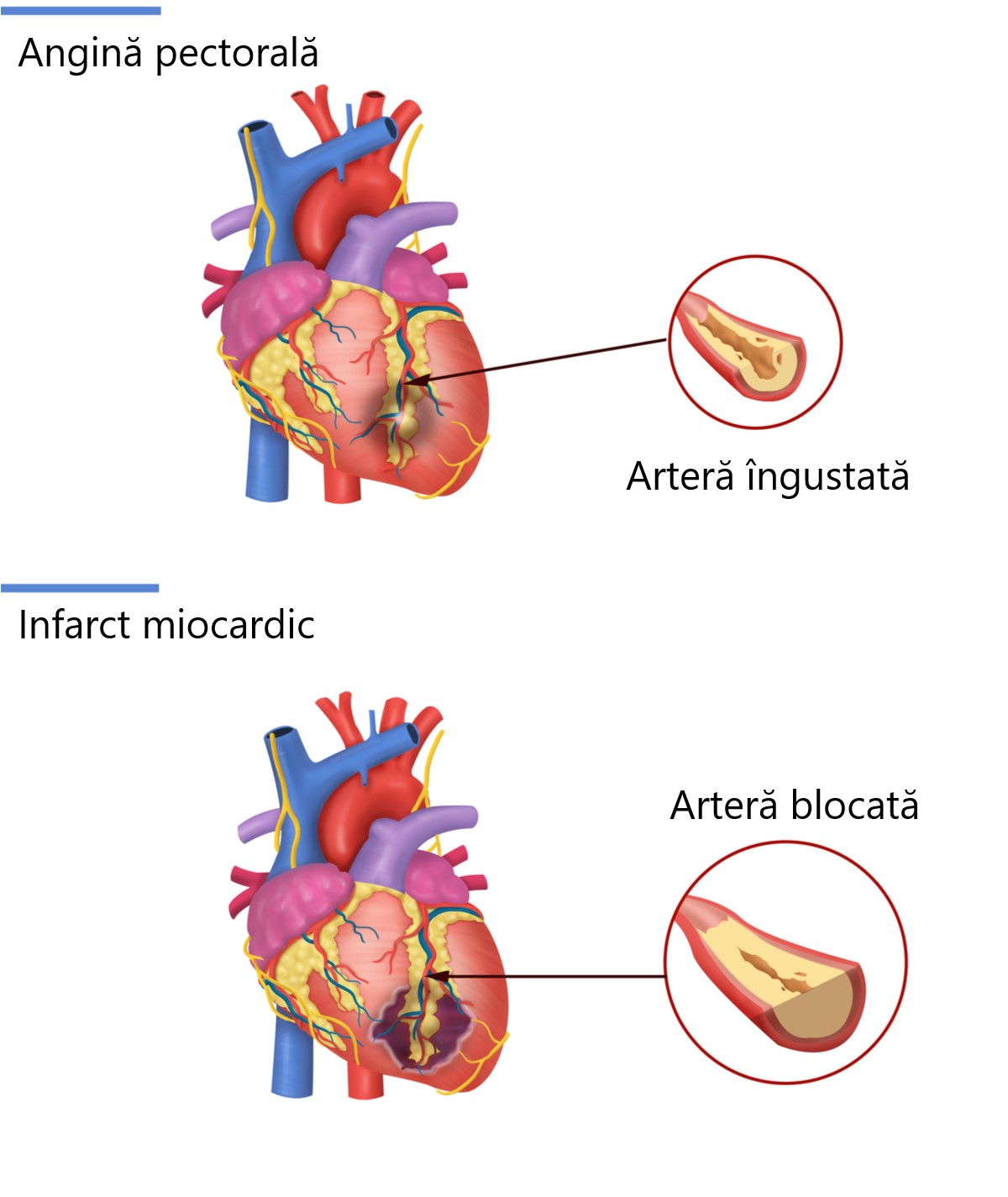 cum-se-simte-angina-pectorala-si-cum-se-deosebeste-de-infarct grafic angina sau infarct