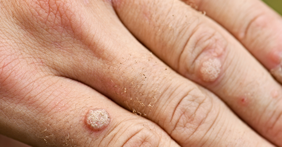 negi-tipuri-cauze-tratamente-eficiente-si-preventie veruci vulgare