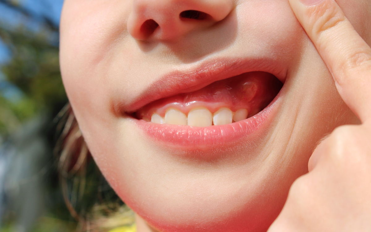 abces-gingival-diferit-de-abces-dentar-tratament abces pe gingie