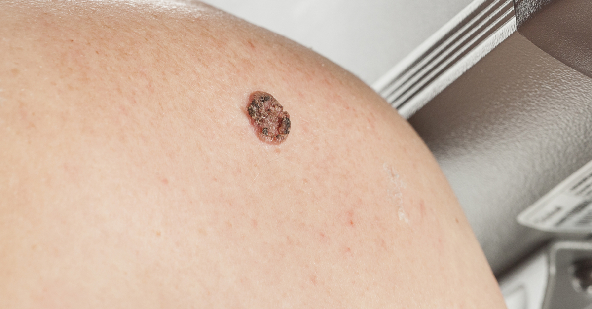 negi-tipuri-cauze-tratamente-eficiente-si-preventie carcinom cu celule scuamoase