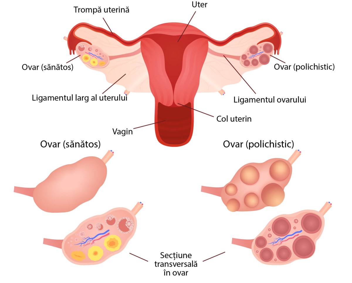 sindromul-ovarelor-polichistice-poate-provoca-infertilitate-si-diabet grafic ovare polichistice