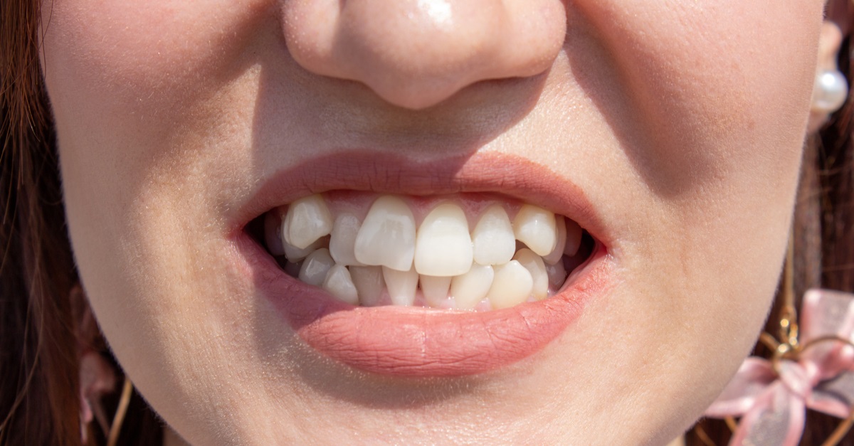 aparat-dentar-cand-e-necesar-si-care-sunt-cele-mai-moderne-tipuri inainte si dupa dinti inghesuiti