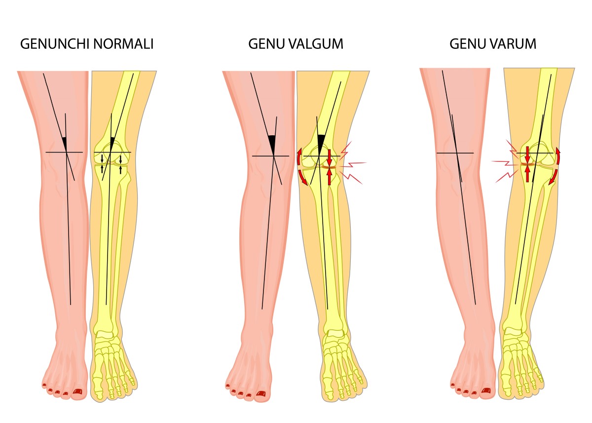 gonartroza-simptome-cauze-si-optiuni-de-tratament genu varum genu valgum