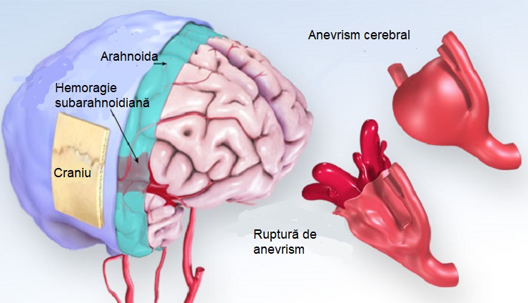 anevrism cerebral poze