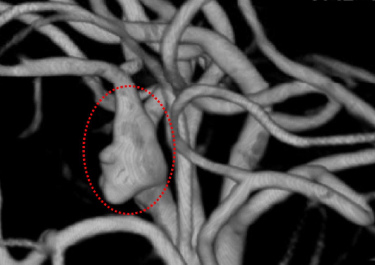 anevrism cerebral poze