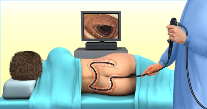 Colonoscopie procedura