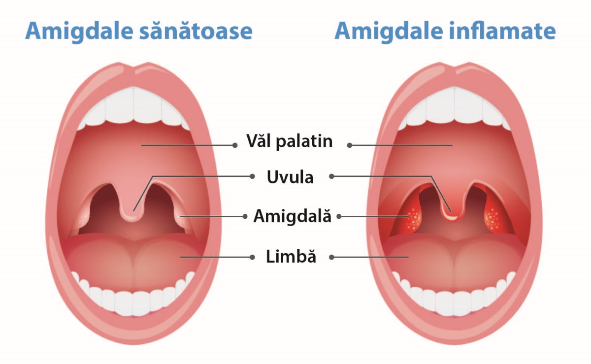 amigdalita si amigdale sanatoase