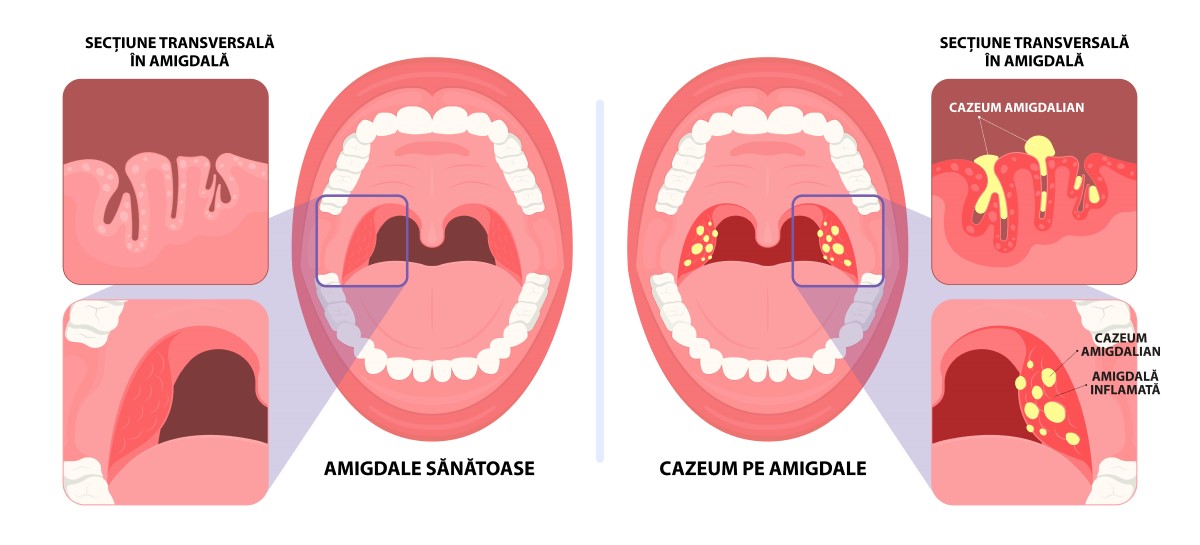 amigdalita. cazeum pe amigdale