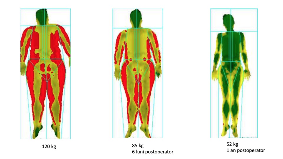 chirurgie-bariatrica-operatie-micsorare-stomac-cand-e-indicata analiza DEXA