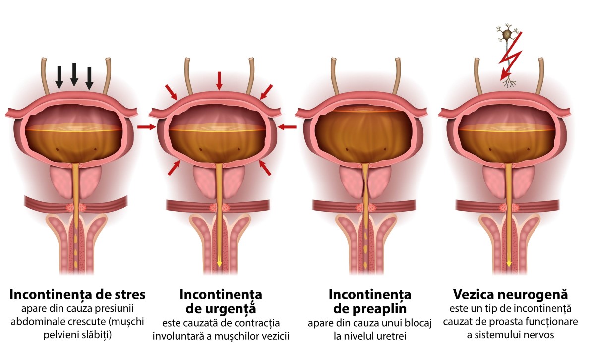 incontinenta-urinara-cauze-si-cele-mai-bune-solutii-de-tratament tipuri de incontinenta urinara