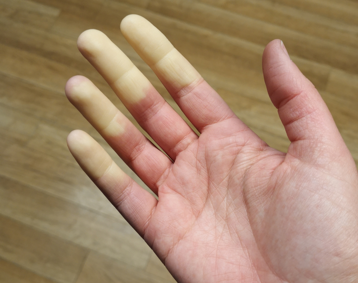 sindrom raynaud