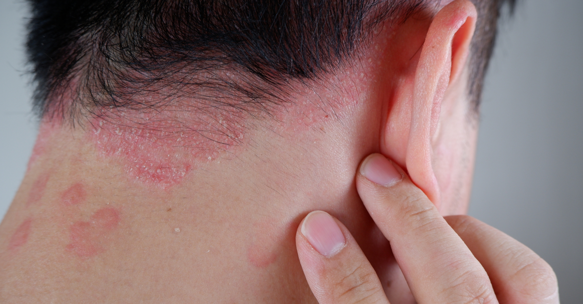 Psoriazis scalp: cele mai eficiente metode de tratament ceafa