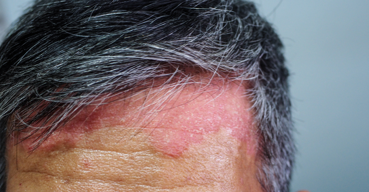 Psoriazis scalp: cele mai eficiente metode de tratament linia parului si frunte