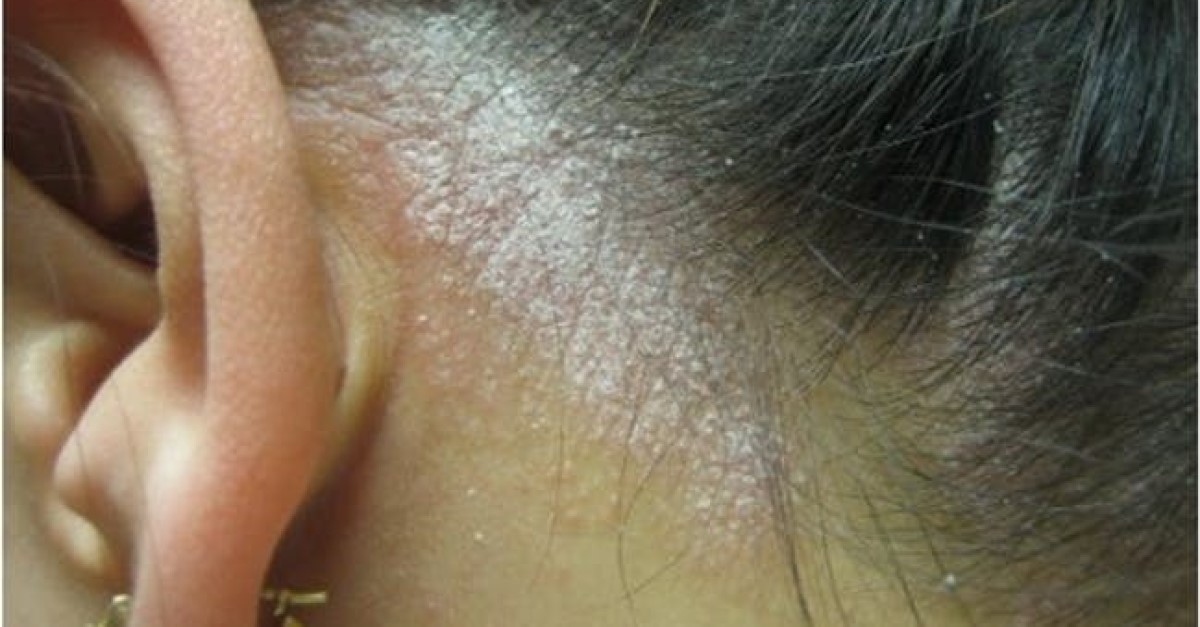 Psoriazis scalp: cele mai eficiente metode de tratament in spatele urechii