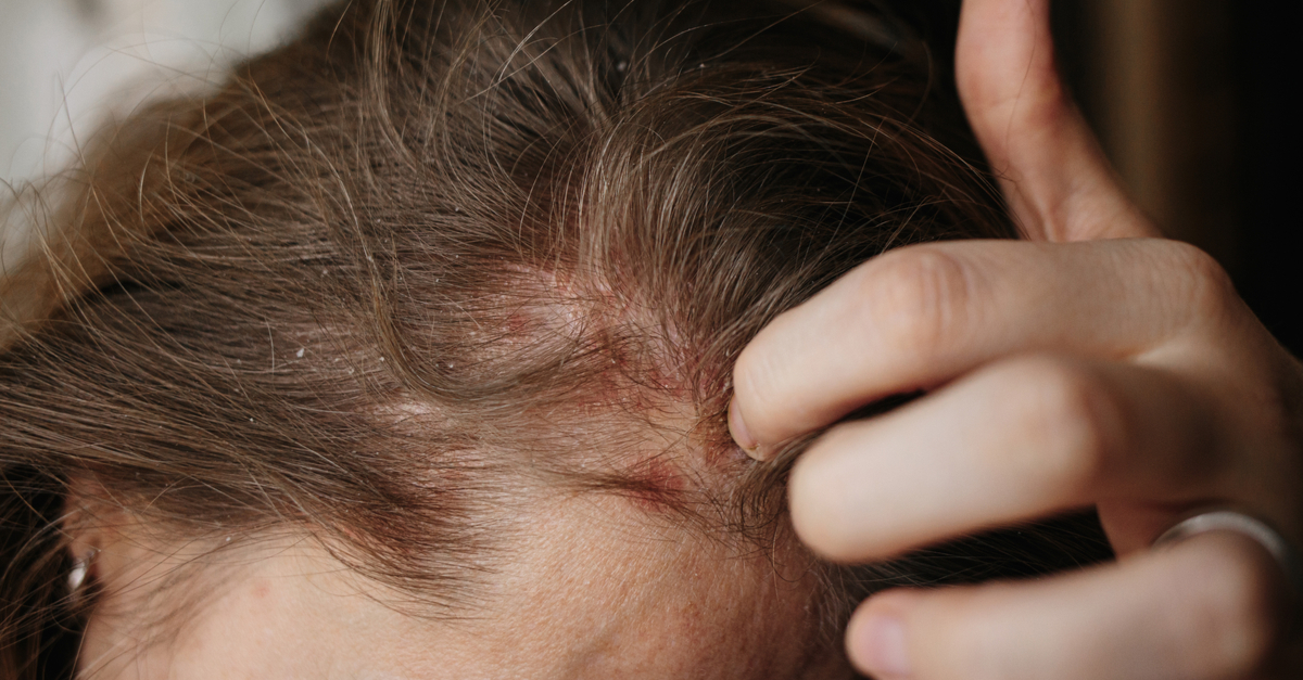 Psoriazis scalp: cele mai eficiente metode de tratament