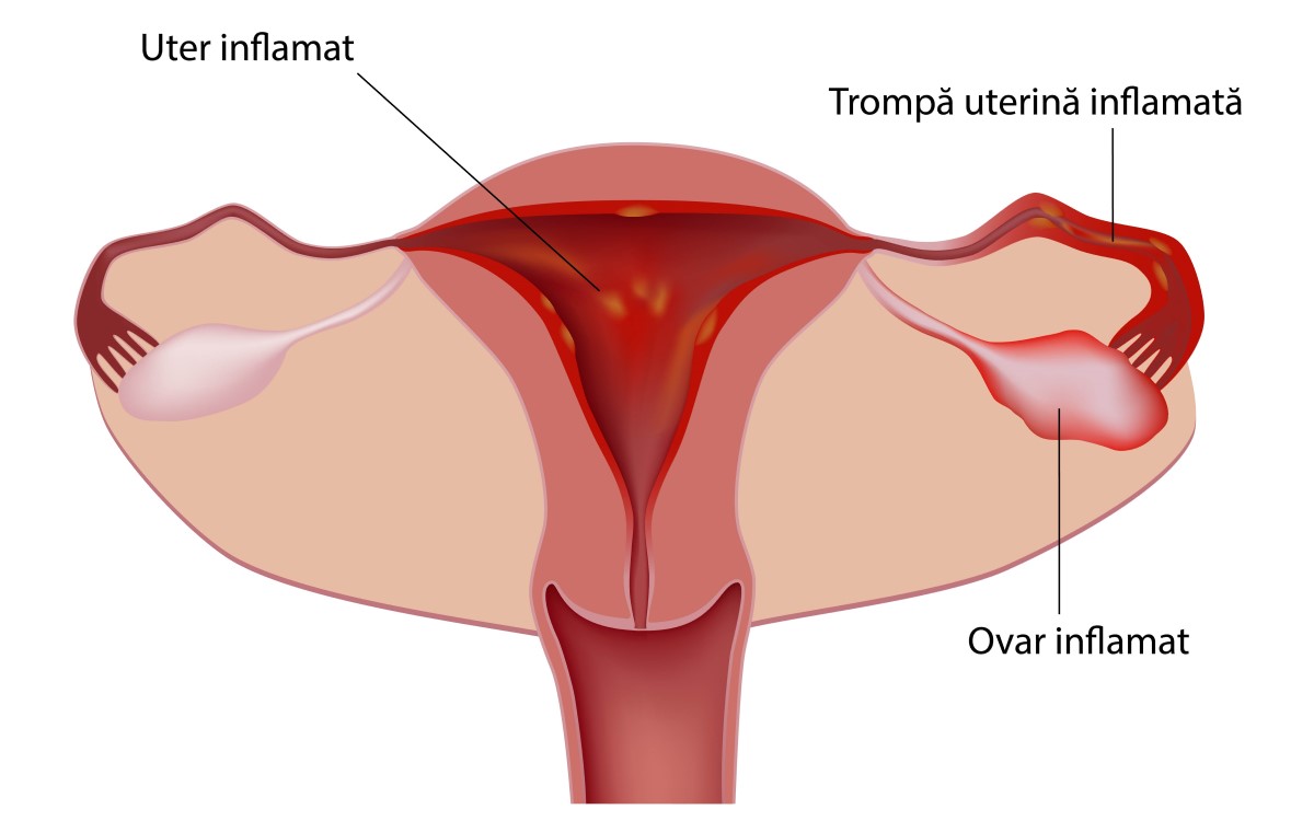boala-inflamatorie-pelvina-cauza-de-infertilitate trompa inflamata
