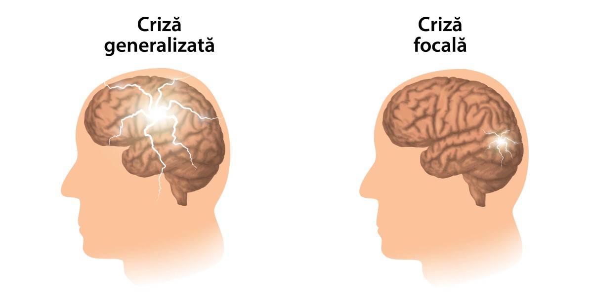 epilepsie-simptome-crize-si-metode-moderne-de-tratament criza focala si generalizata